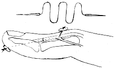 Ӧ��Bunnell��˫������˫ť�ۼ����������ƴ�״ָ