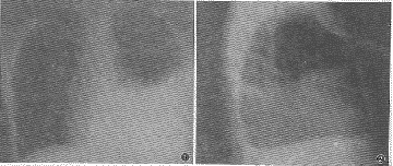 ��75�������ظ���ʹ�����ʡ�Ѫ����ǻ��Һ