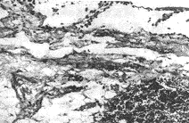 ��Ĥëϸ�ܰ͹�����֢���������ˮ1��