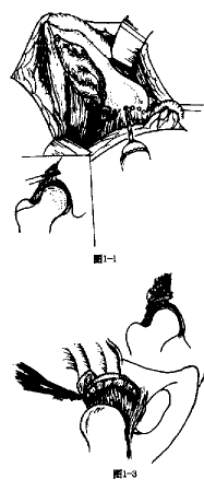 Staheli��s�������ƶ�ͯ�žʷ��������ĳ�����Ч�۲�