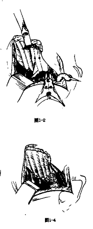 Staheli��s�������ƶ�ͯ�žʷ��������ĳ�����Ч�۲�