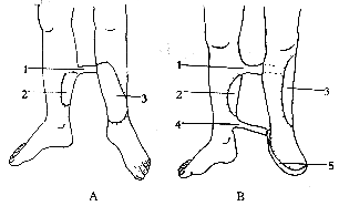 �����ֺ�Ѫ��Ƥ����Я������Ƥ���ٴ�Ӧ��