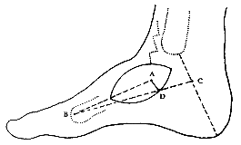 �������ڲ�Ƥ��Ľ����о����ٴ�Ӧ��