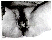 ��״Ƥ�ꡢ��Ƥ����ٴ�Ӧ��