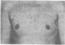 ��ǰ���֬����Ĥ��������ֲ¡����һ��