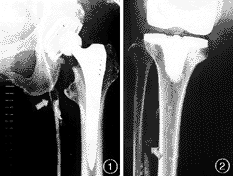 �˹��ؽ��û�������֫���Ѫ˨�γ�