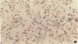 ��Ѫ��ϸ��p53��bcl-2�����뻯��ҩ���յ������Ĺ�ϵ