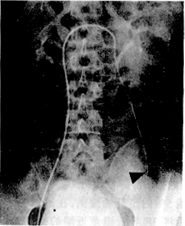 ͬ���ܾ�ƤԶ��Ӳ��˨�����ƾ�����������