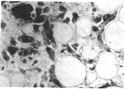 HMB-45����Ѫ��ƽ����֬����