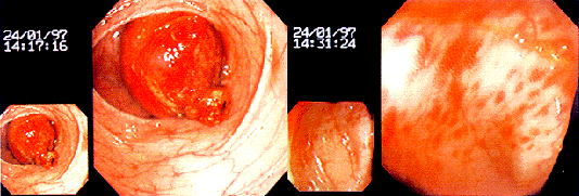 �᳦�޴�֬��������Ѫ�ܷ�������һ��