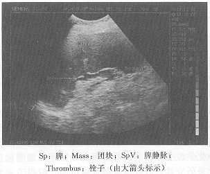 B������ƢѪ��������Ƣ������˨1��