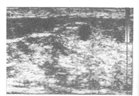 ���ٵ�������֢������ͼ����1��