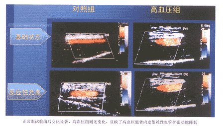 ԭ���Ը�Ѫѹ����Ѫ����Ƥ���Ź��ܵĳ����о�