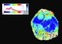 MRI�������ټ����ֲ�ȵ�ϸ��