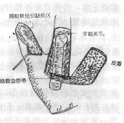 ʳָ����Ĥ�ٵ�״Ƥ����ٴ�Ӧ��