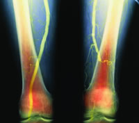 ��Ѫ������ת��Ԥ������