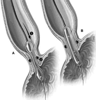 ����ʧ�ڻ�֢:�������������ⶾ�˾�����ע��