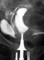 �������ƶ�Ic���ӹ���Ĥ����������