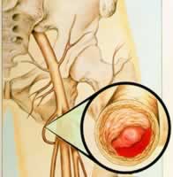 �й��ǿƴ��������Ѫ˨�γ�Ԥ��ר�ҽ���(��)