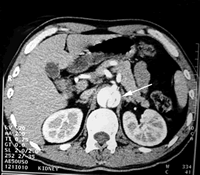 3rd Military Medical University succeeds in intraluminal
    treatment of multi-cavity dissection of aorta