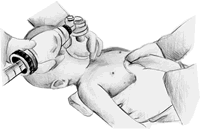 �۽�2005AHA�ķθ�������Ѫ�ܼ���ָ��(��)ҽ����Աʩ��ʱ�Ļ����͸߼�����֧�ֵ��޸�