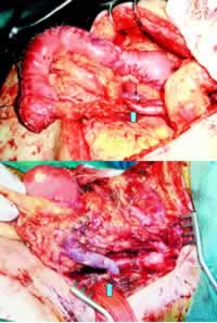 ʳ�ܴ�ȫ����������θѪ���¼���