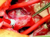 ���껼��CABG��PCIԶ��Ԥ��Ƚ�