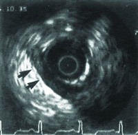 Ѫ���ڳ������о����̡���״�뷢չǰ��