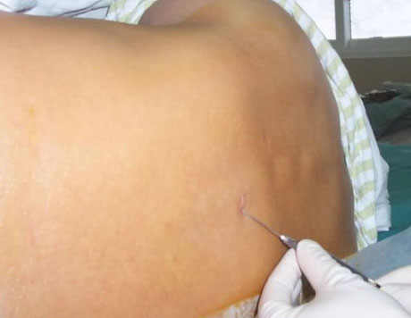 ӲĤ����������ʾ��ͼ