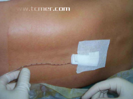 ӲĤ����������ʾ��ͼ