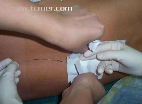 ӲĤ����������ʾ��ͼ