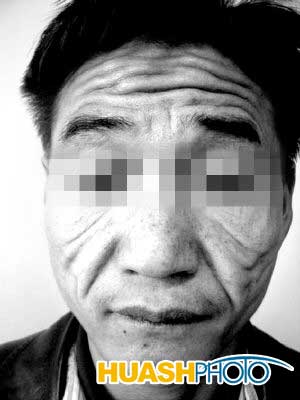 21��С�ﻼƤ���ɳ�֢��60����ͷ �ؼҸ�ĸ��ʶ