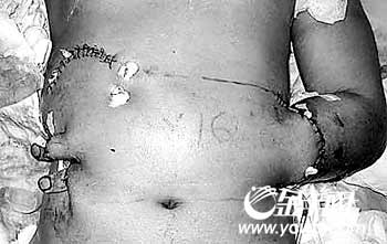 ҽ�������˲�֫����丹�� �ڴ�20�������ͼ