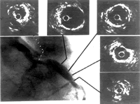 Ѫ���ڳ����Ͷ����ռ����ڹ�״�����������ź�Ѫ�������ۺ����е�Ӧ��