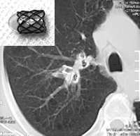 ��֧���ܾ�����μ������������ض�COPD