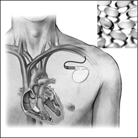 ICD������:��3֬�����޿���������ʧ������