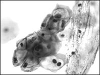 �����ḾŮ��������ɸ ��ѡHPV���+Һ��ϸ��ѧ���