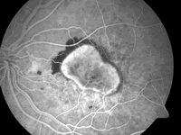 FDA��׼ʪ����������� �ư߱�����ҩRanibizumab