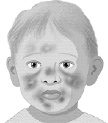 ��������Ī˾���⻯�ɵ��ɲ�Ӱ���ͯ����Ӧ��