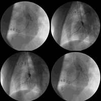 �л�ҽѧ��ھŴ�ȫ����Ѫ�ܲ�ѧ������(��)ͨ�緽��������֢��������Ƥ���ȶ��߿顢������ʧ�������о���չ