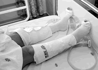 Ԥ�����Ѫ˨�γɼ�ѹ�����೤�Ȳ�Ӱ��Ч��