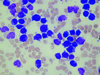 ����������ϸ����Ѫ�����ߴ��ڳ�Ѫ��Ѫ˨�γ�˫��Σ������Ӱ��������Ŀǰ������Ч��Ԥ��ʩ