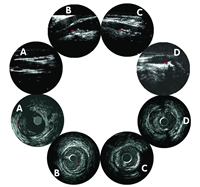 �߿����ѿ���֪ IVUS��hs-CRP��Ԥ���Ľ�ʹ���߹�״�����߿�����