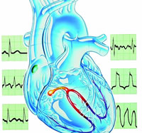 �ĵ�ͼ�����쳣����ARVD ����/֫�������ĵ�ͼ����߼����