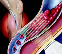 ˫�ض���MRI�ɼ�⼰��ʾDVT��Χ