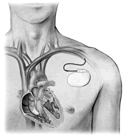 ����ʽ�������������׵��¸�Ⱦ