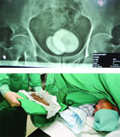 ������ˮ̶ҽԺΪһ�����߻�����׾�ʯ