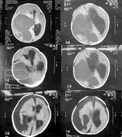 �Ϻ���ͯҽѧ��������Ƴɹ�ժ��1������Ӥ�Բ��޴�����