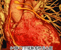 ��ǰ������CABGԶ��Ԥ���� ����MACE���,Զ��ȫ������Σ�ձ���ǰ��������߸�40%