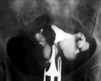 ��ǻ���������ѹ��Բ���֢